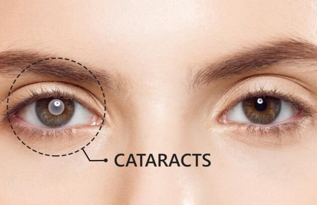 Cashless Cataract surgery