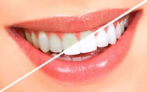 Smile Designing and Veener Treatment